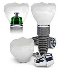 Dental Implants in Forest Hills