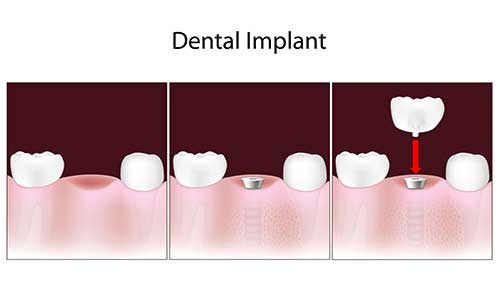 Dental Implants Forest Hills