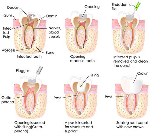 Forest Hills Root Canals